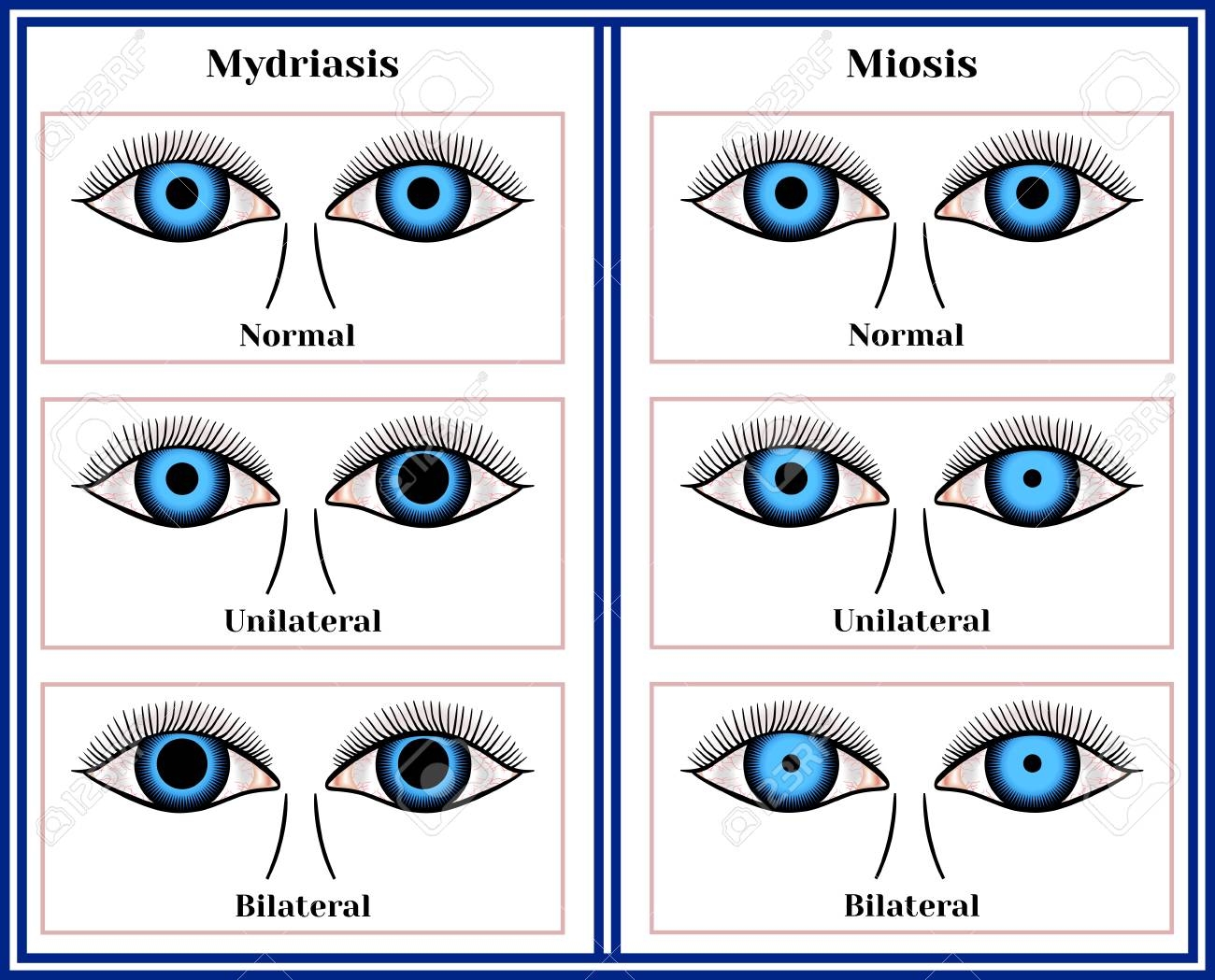 Mydriasis Expansion Of A Pupil And Miosis Narrowing Of A Pupil Chart Illustration Royalty Free SVG Cliparts Vectors And Stock Illustration Image 92035764 Mydriasis Expansion Of A Pupil And Miosis Narrowing Of A Pupil Chart Illustration Royalty Free SVG Cliparts Vectors And Stock Illustration Image 92035764