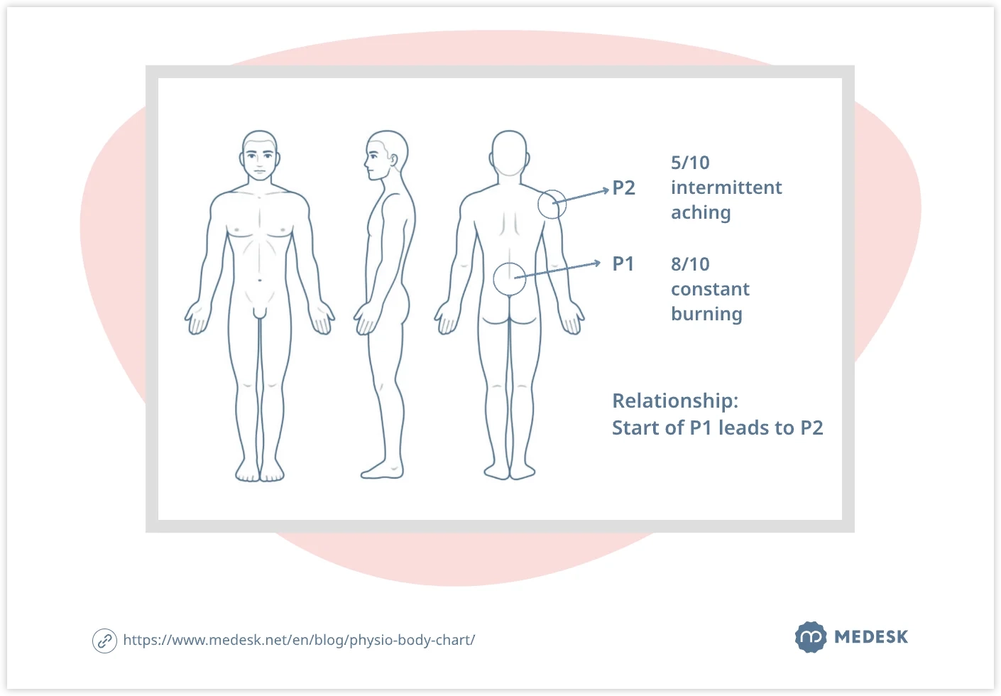 Physiotherapy Body Chart Theory Examples And Recommendations